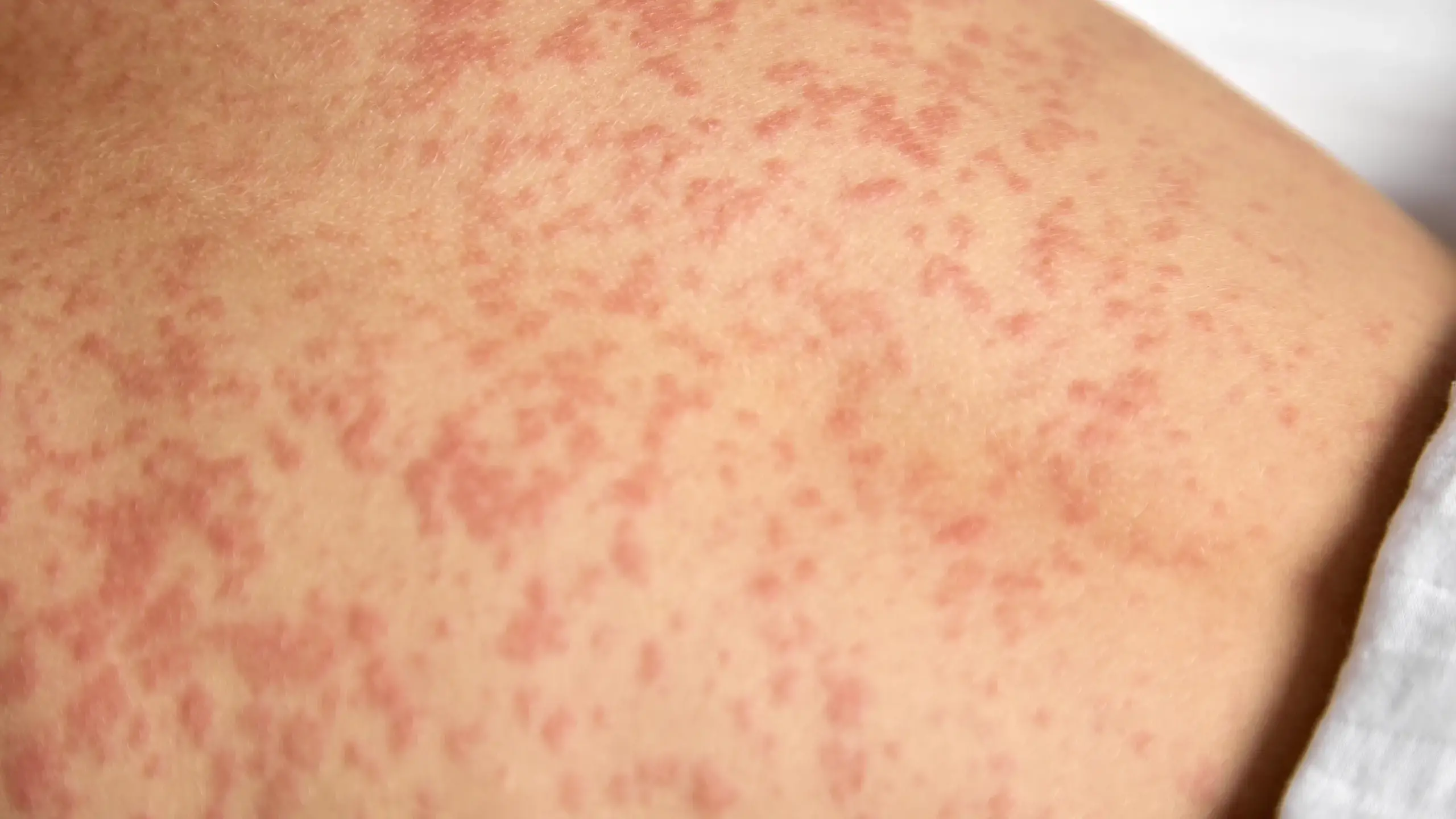 Measles alert for Central West